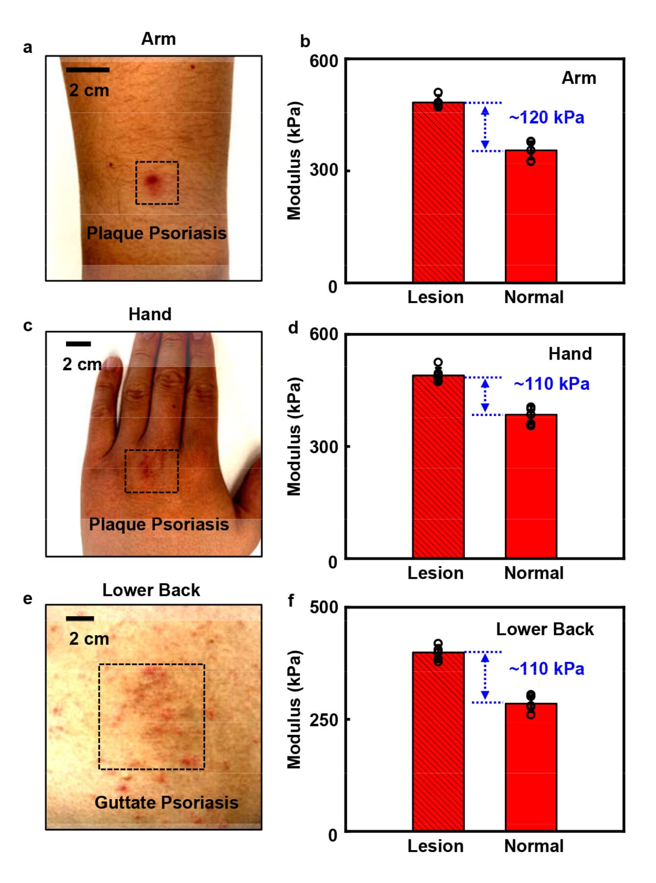 The team applies the device on the skin lesions associated with psoriasis on the arm (a), hand (c), lower back (e) and the unaffected skin. Figure b, d and f show the results of stiffness variations between unaffected skin and lesion regions. (Photo source: Song, E., Xie, Z., Bai, W. et al. / DOI number: 10.1038/s41551-021-00723-y)