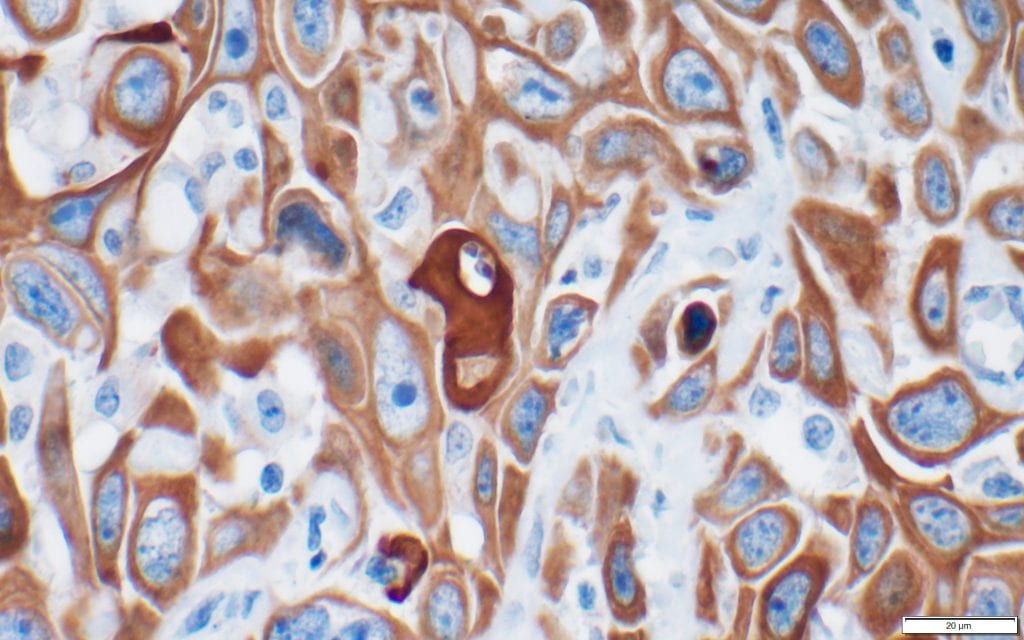 Microscopic image showing brown, antibody-based staining of keratin 17 (K17) in bladder cancer. Credit: Shroyer Lab, Stony Brook University