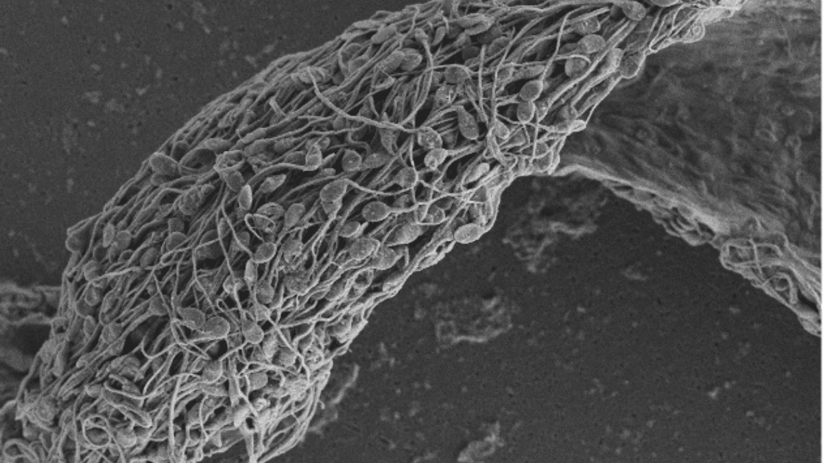 A scanning electron micrograph of human sperm stuck together and immobilized by an antisperm antibody.
