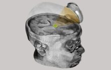 Slowing down dementia-related brain breakdown by using ultrasound