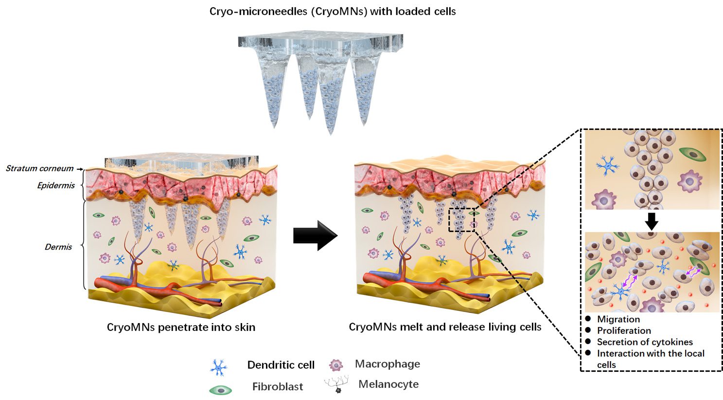Schematic illustration of the transdermal delivery of cells using cryomicroneedles.