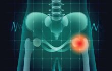 Reducing the need for hip replacements by 10 percent using stem cell therapy
