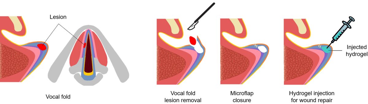 Illustration shows the use of injectable hydrogel as an implant to fill a wound and to restore the voice. Credit: Sepideh Mohammadi / Utilisation de l’hydrogel injectable comme implant pour obturer la lésion et restaurer la fonction vocale. Image : Sepideh Mohammadi