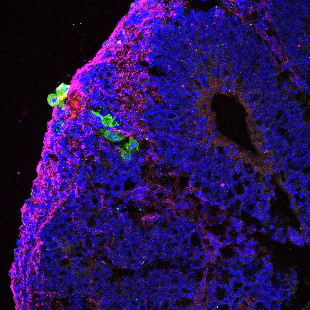 Cross-section of a retinal organoid, showing hybrid cells (green) engrafting onto the tissue. Red fluorescence indicates the activity of new ganglions being formed. Credit: Sergi Bonilla/Lancet eBioMedicine