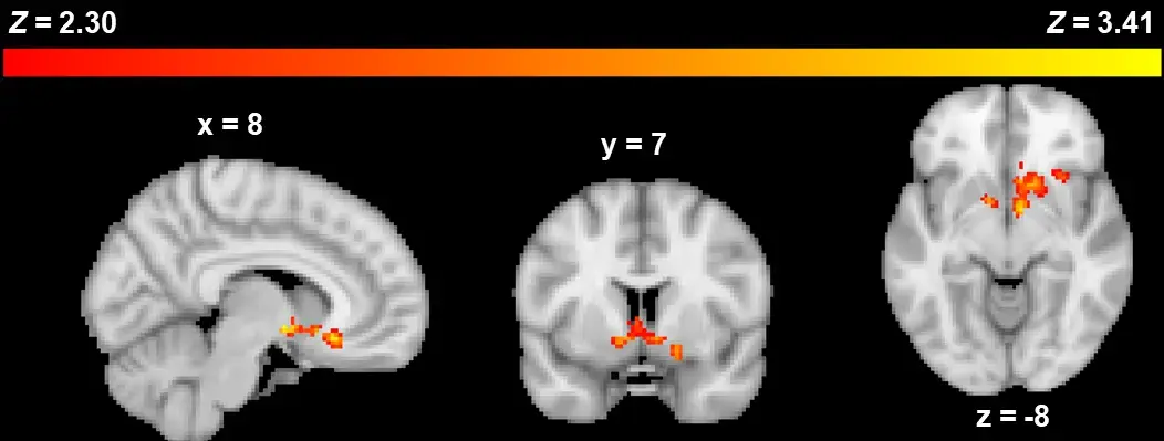 A brain scan image from the study, showing activity in the brain's reward network. (Image contributed by David Chester.)