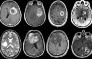 Starving brain tumours for energy: A promising basis for developing effective medications for glioblastoma