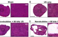 Removal of tumors without surgery using ultrasound and nanobubbles
