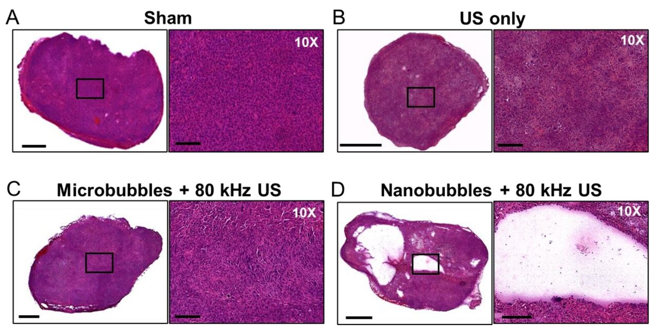 A combination of ultrasound and nanobubbles allows cancerous tumors to be destroyed without invasive treatments