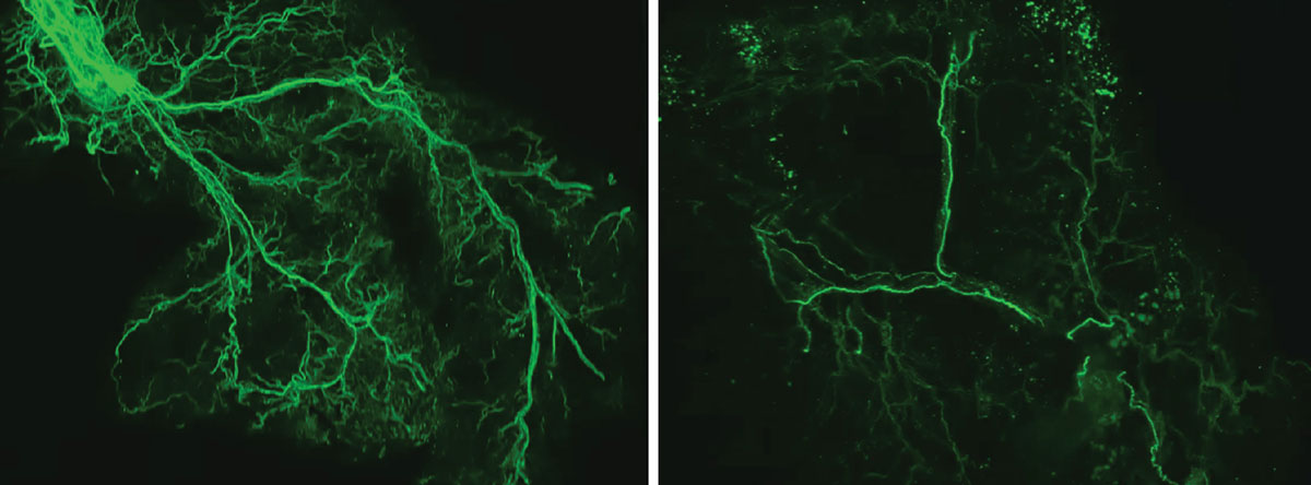With age, the researchers found that the protein Ppp1r17 tends to leave the nucleus of the neurons, and when that happens, the neurons in the hypothalamus send weaker signals. With less use, the nervous system wiring throughout the white adipose tissue gradually retracts, and what was once a dense network of interconnecting nerves (left) becomes sparse (right). Credit: Kyohei Tokizane